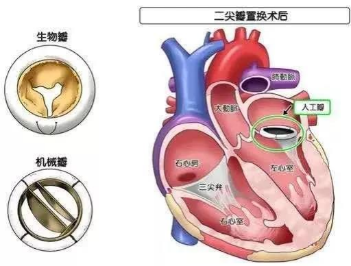 胸腔镜瓣膜置换术:不用"开胸劈骨"的心脏手术!